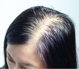秀丝顿鹿邑植物养发馆温馨提示什么是女性脱发？