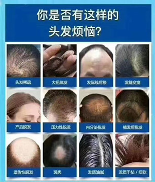 为什么脱发大多数只脱头顶？