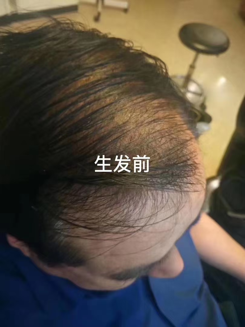 生发该注意什么