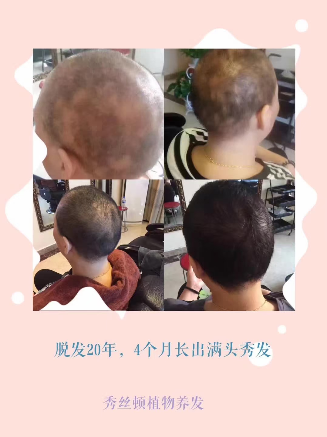 斑秃专题