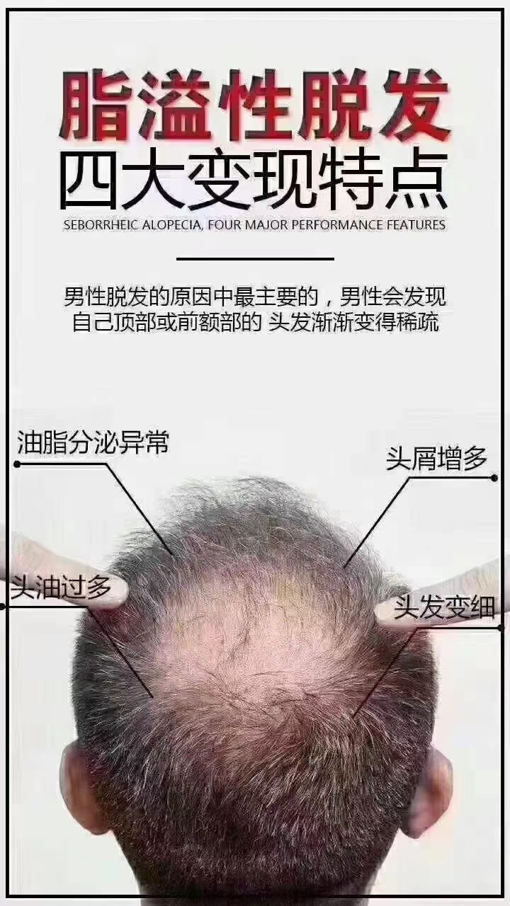 脂溢性脱发