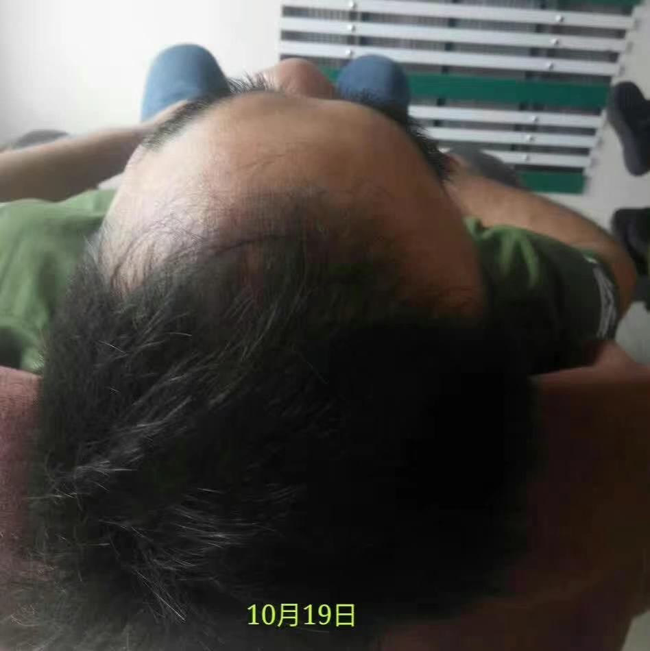 生发效果