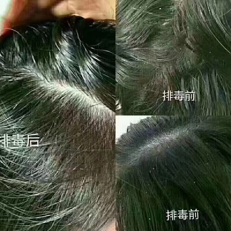 头皮屑知识
