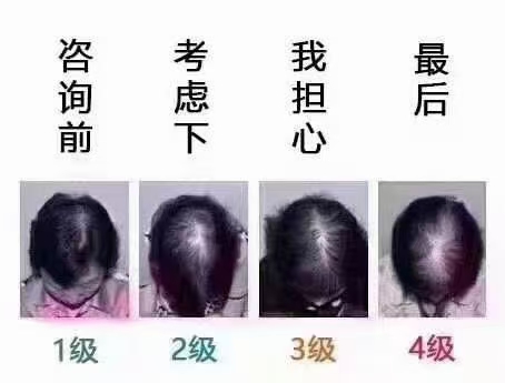 头皮屑是怎样产生的