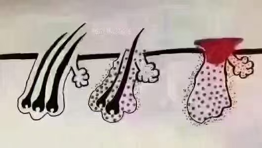 毛囊问题