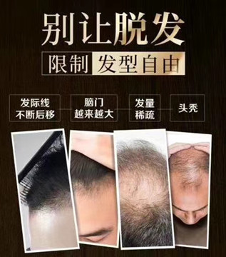 如何判断自己在大量掉发
