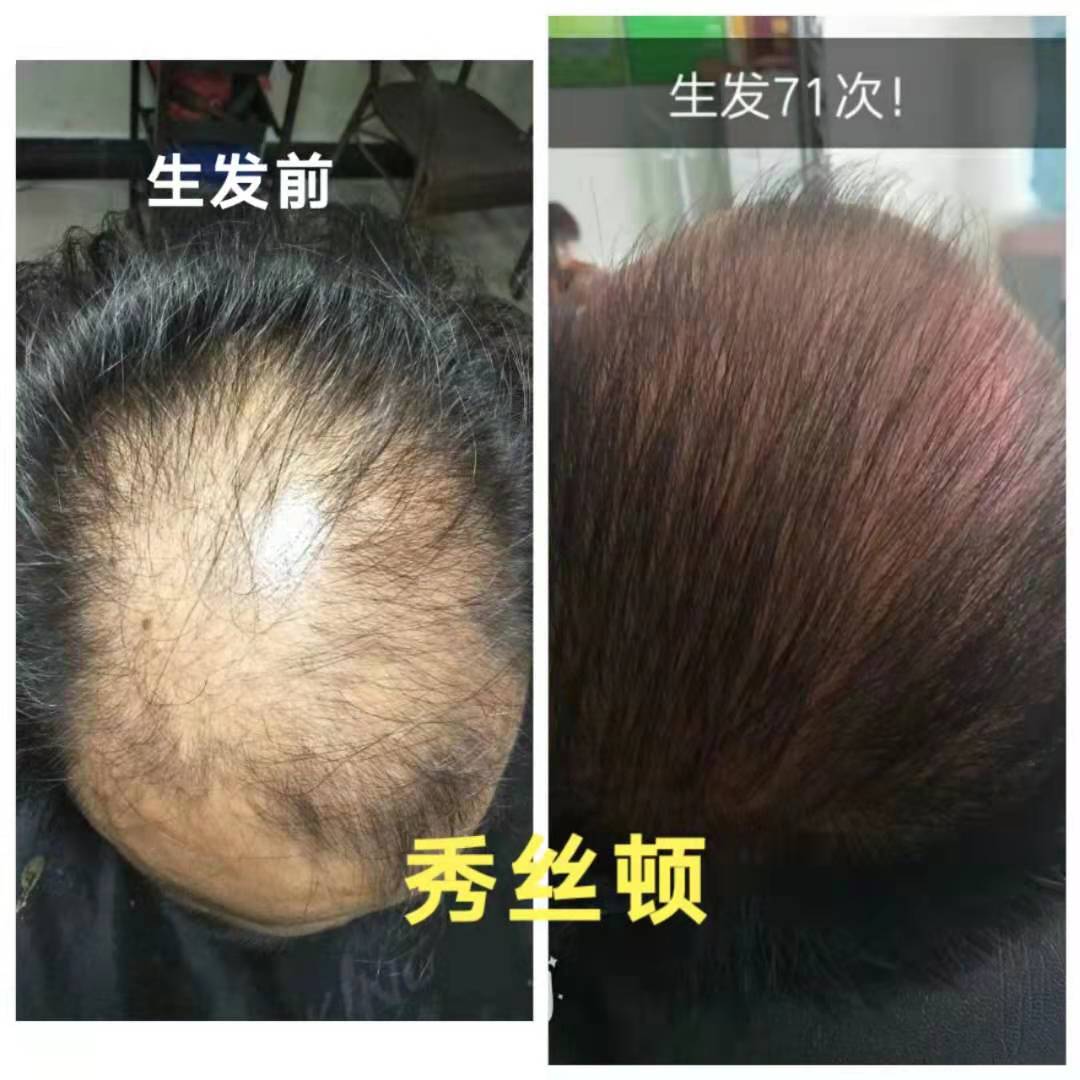 脱发原理