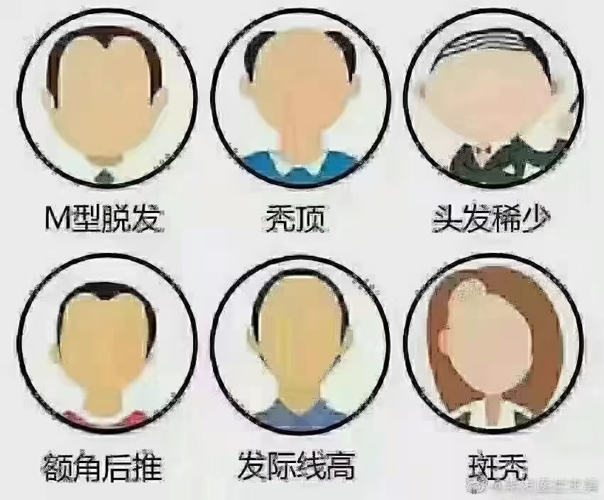 有这5种情况说明你正在走向脱发
