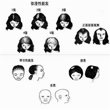 什么是脂溢性脱发