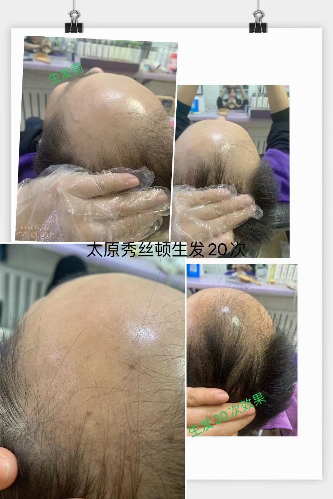 KPT自然免疫疗法展示