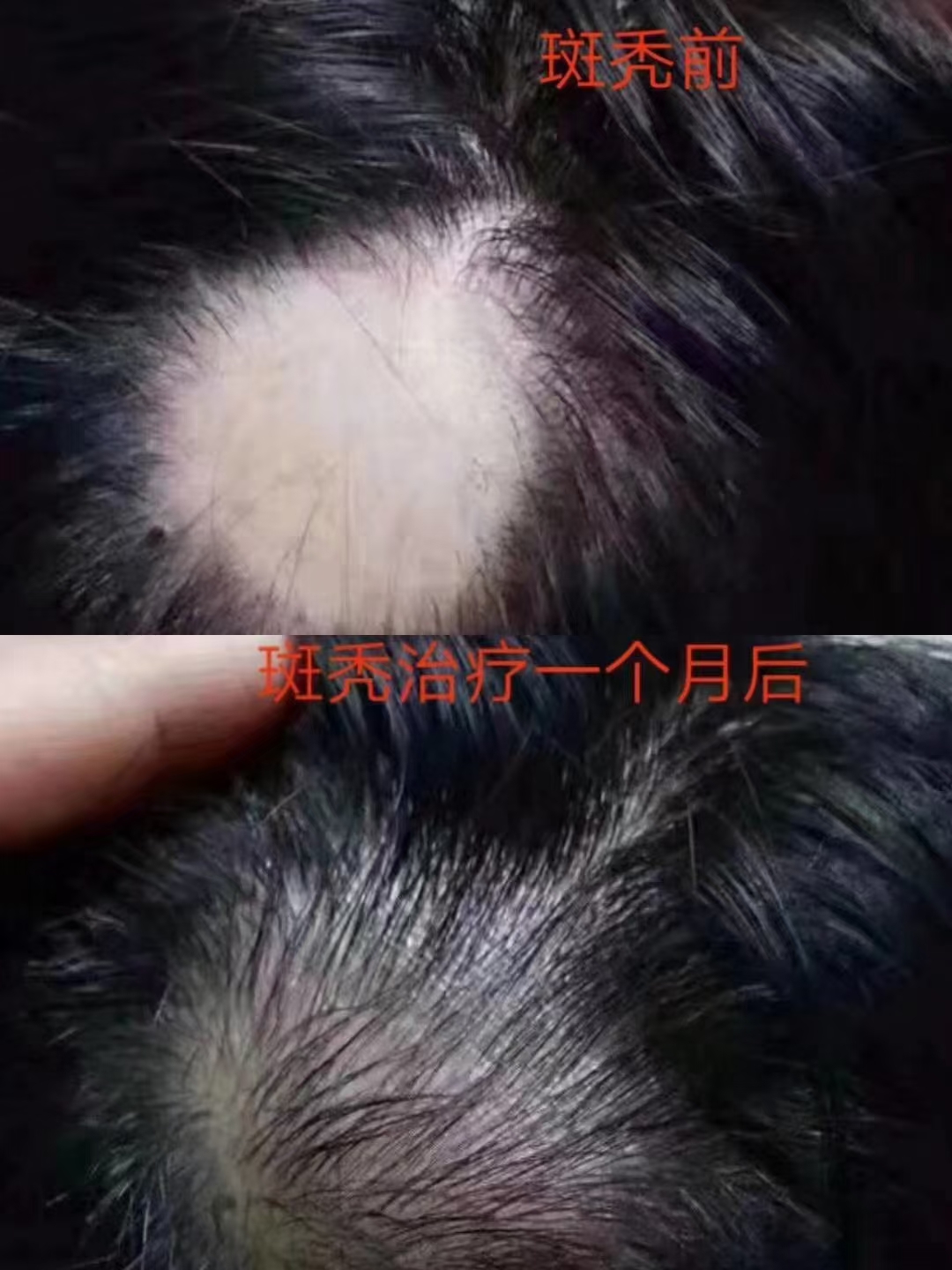 什么是斑秃