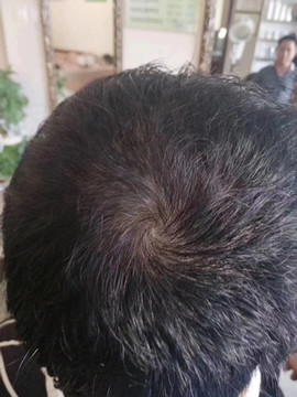 头发分叉-----往往是多种头发损伤的综合结果
