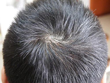 白发患者平时可以多吃黑豆，黑芝麻等