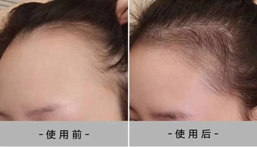 为什么洗头发掉发很严重