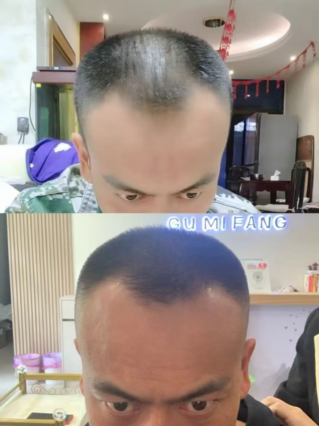 蓬溪店生发效果