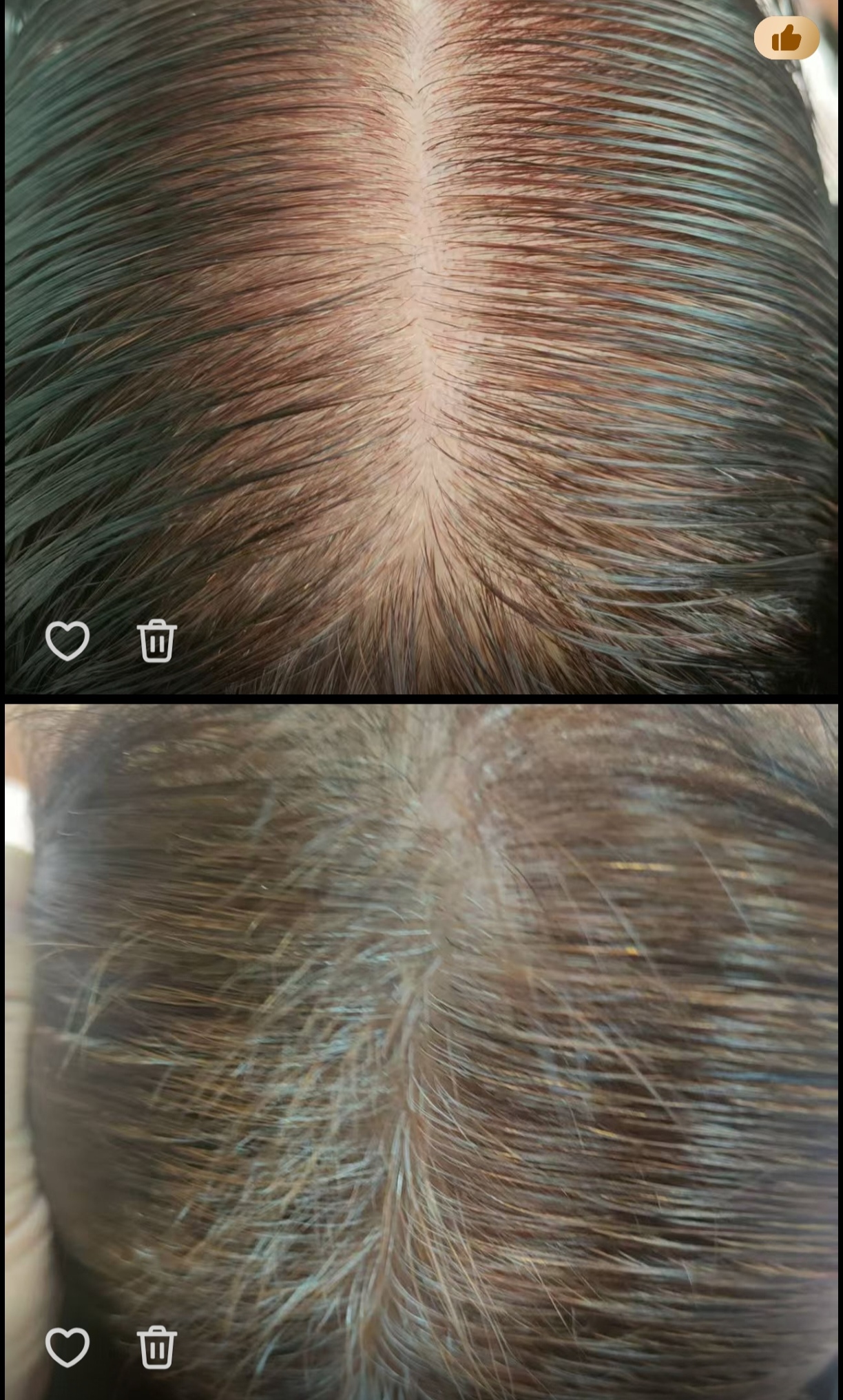 邯郸店生发效果