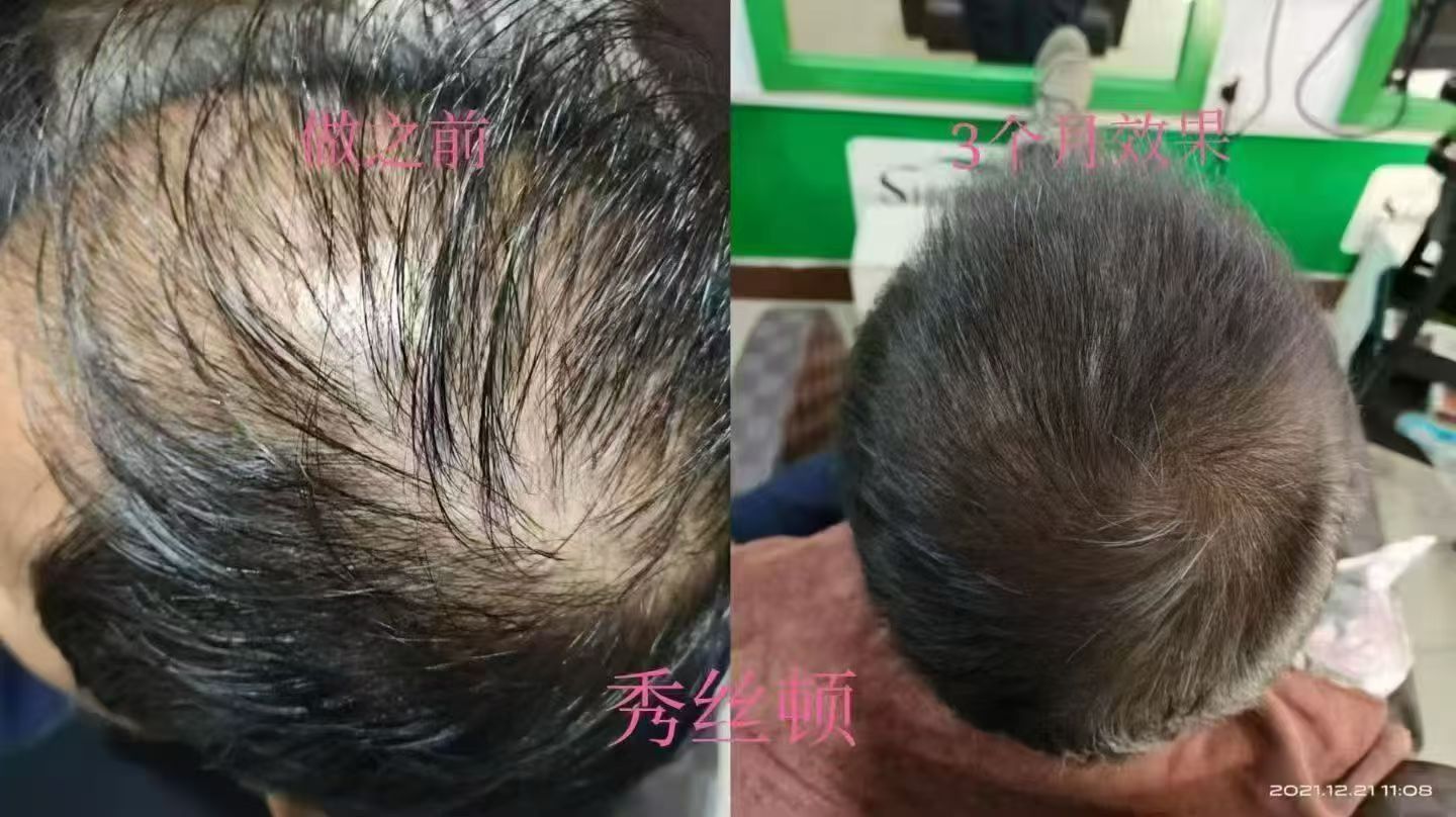 生发效果
