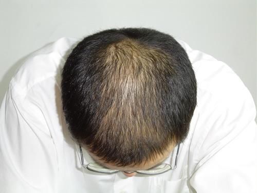 秀丝顿植物养发馆加盟之脱发严重应先明确病因